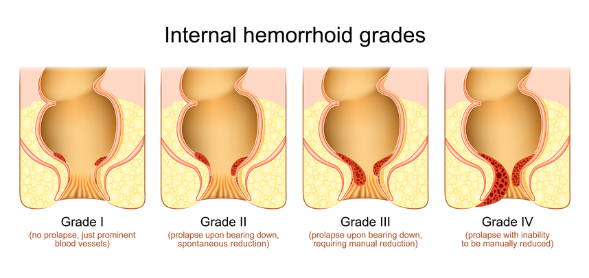 hemorrhoid grades